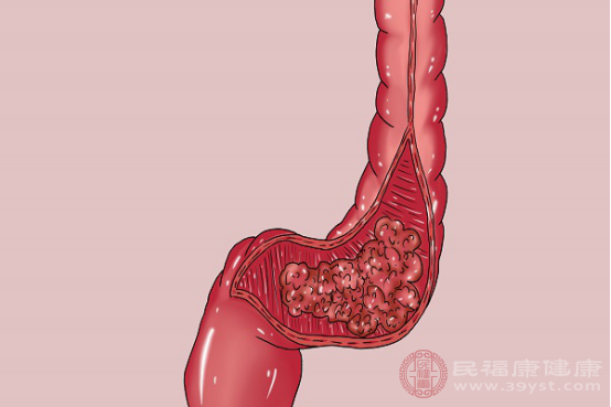 肠癌的病因非常复杂，大部分患者得肠癌的病因是细胞分裂异常或者基因突变