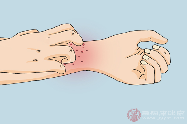 身上出现热痱以后，患者可以用去痱软膏进行治疗