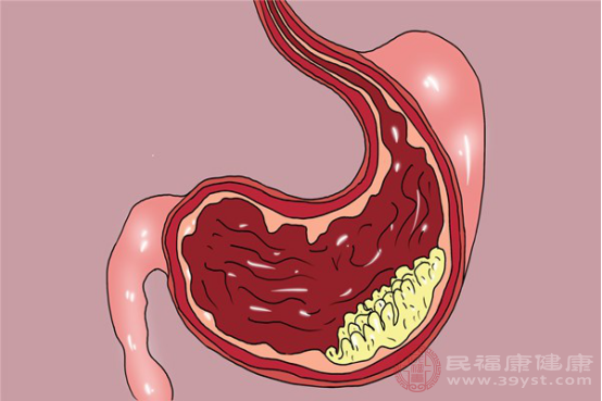 胃部手術(shù)史超過(guò)五年的患者會(huì)出現(xiàn)大便沒(méi)有形狀、水腫和吞咽困難等癥狀