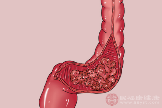 直腸癌的發(fā)生，多數(shù)情況下會出現(xiàn)便血的現(xiàn)象，這也是直腸癌早期階段最常見的癥狀