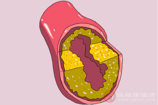 人們患上主動(dòng)脈粥樣硬化的原因，大多數(shù)都是與生活習(xí)慣不佳有關(guān)