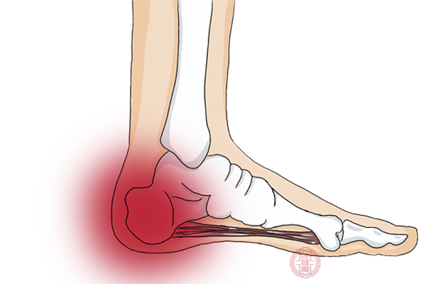 這些老年人雖然患上了足跟骨刺，但是不一定會出現(xiàn)明顯的不適感
