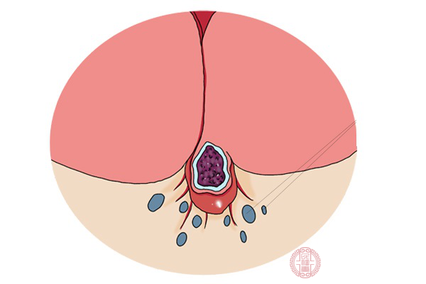 　會導(dǎo)致痔瘡的原因有很多，但是大部分的原因都跟生活習(xí)慣有關(guān)