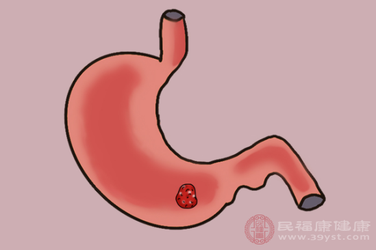 一般來說，胃癌在早期階段時(shí)，通常不會(huì)有明顯的癥狀表現(xiàn)出來