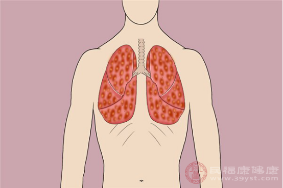 如果肺癌患者已經(jīng)進(jìn)入晚期，他們可以接受姑息治療