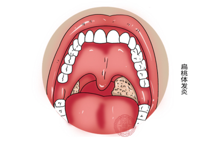 扁桃体发炎主要是细菌炎症感染所致