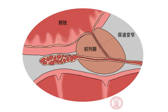 怎么治疗慢性非细菌性前列腺炎