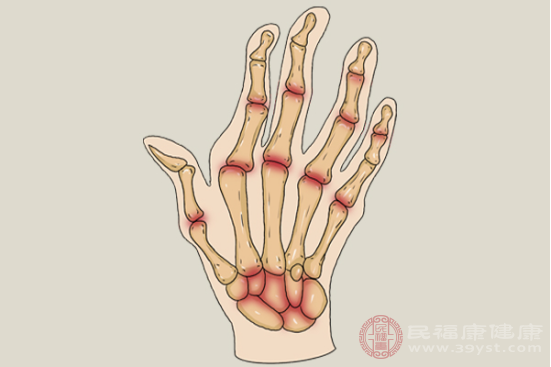 類風濕關(guān)節(jié)炎屬于病因還沒有明確的風濕免疫性疾病