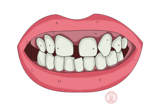 1,牙齿矫正如果人们牙齿有缝隙比较大,可以通过牙齿矫正技术来修复