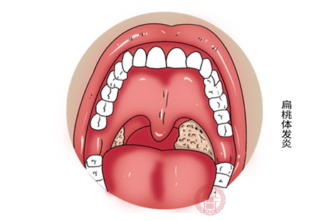 一般感冒时发现自己咽喉部位出现疼痛等不适症状，可以考虑是扁桃体发炎