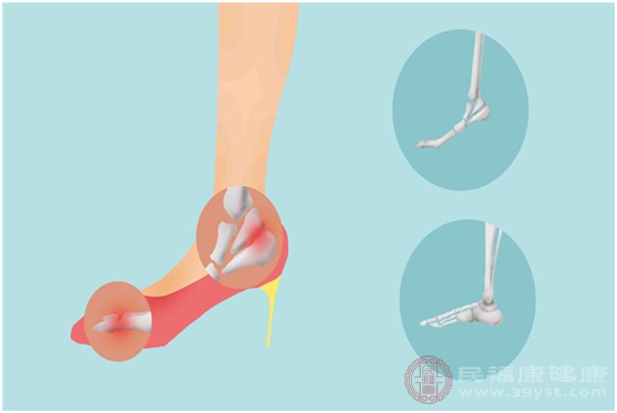 腳腕疼的病因包括外力沖擊、穿過緊或者過小的鞋襪和骨折等