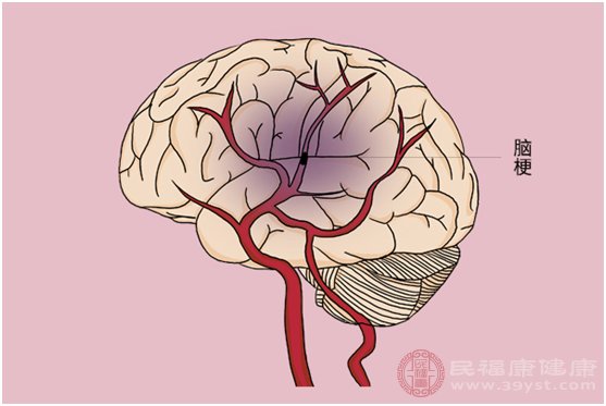 突然嘴歪的病因有很多种，例如面部神经炎、脑梗和中风等