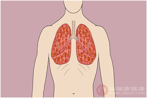 磨玻璃结节是指我们从影像学检查结果中看到的像阴影一样的支气管血管束