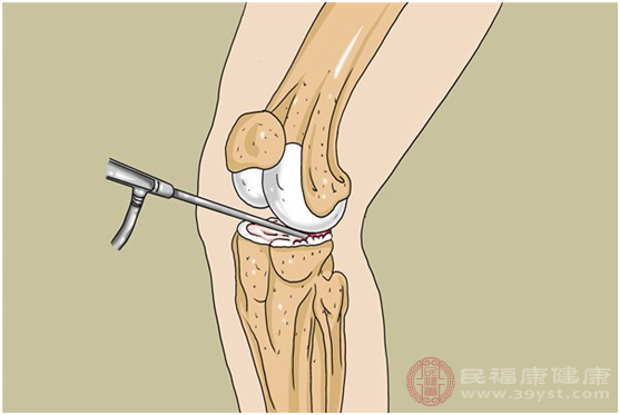 癥狀較輕的半月板損傷患者應(yīng)該接受保守治療