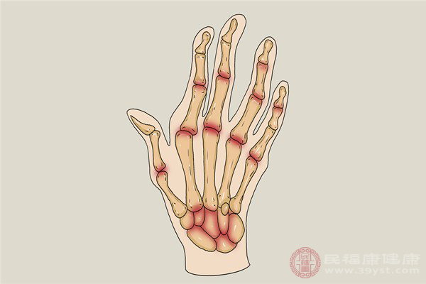 类风湿性关节炎患者早期是能被治愈的