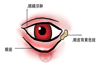 長(zhǎng)針眼是比較常見的眼部疾病