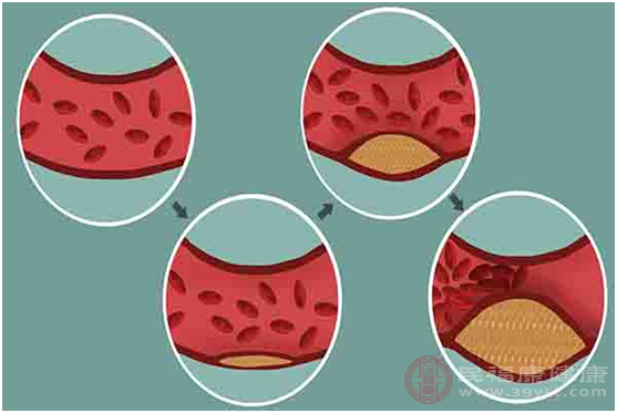 人體膽固醇在偏高以后，可能會(huì)誘發(fā)多種疾病的發(fā)生