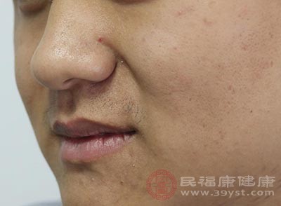 迎香穴是中医治疗鼻炎的常用穴位