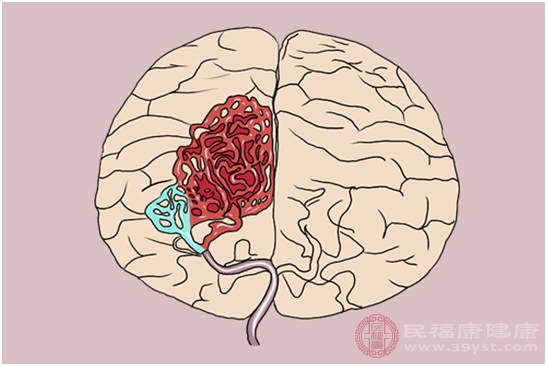 脑动脉瘤患者一定要控制血压