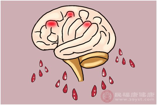 脑出血主要是指没有受到外伤刺激而引起的实质性血管疾病