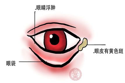 眼皮出现水肿症状是很多人都会患有