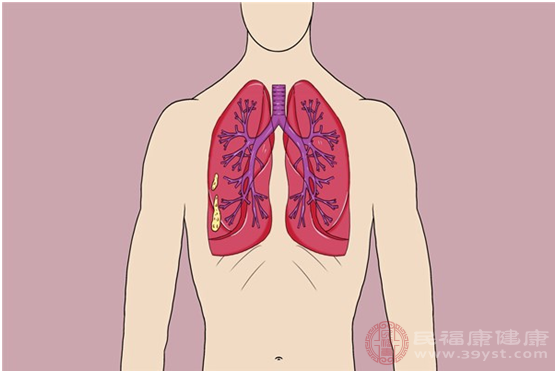 肺结节病患者可以活多久取决于患者的病情变化