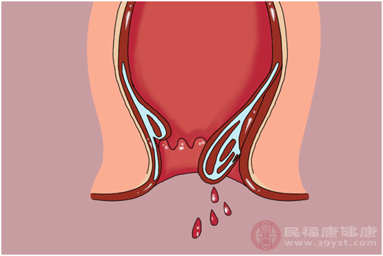 腸息肉疾病是指在腸黏膜表面發(fā)生的突起性異常生長(zhǎng)物質(zhì)