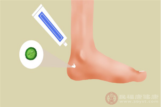 水泡型腳氣患者需要改正錯(cuò)誤的衛(wèi)生習(xí)慣