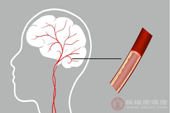 脑血管痉挛是人体的大脑里面的动脉出现了持续性的收缩