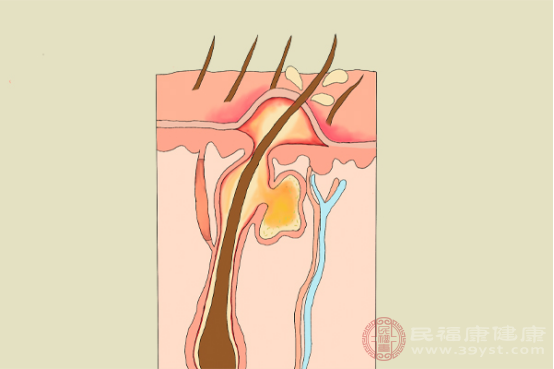 毛囊炎一般多發(fā)生在青少年身上，主要是因?yàn)槠つw上油脂分泌過多