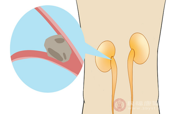 腎結(jié)石是由于一些草酸、尿酸等結(jié)晶物質(zhì)在人們的腎臟部位發(fā)生異常性的聚積以后所引起的疾病