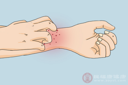 過敏性皮炎患者通常會(huì)有紅斑、丘疹和風(fēng)團(tuán)等癥狀