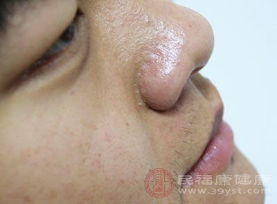 脱敏治疗是过敏性鼻炎治疗的关键