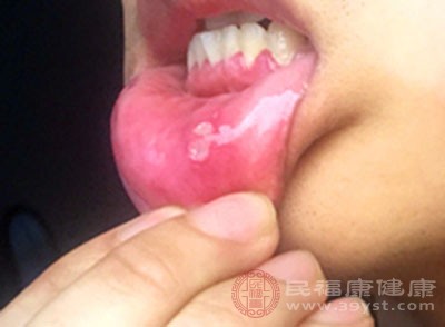 口腔潰瘍這種疾病也有可能是由于外界因素而引發的