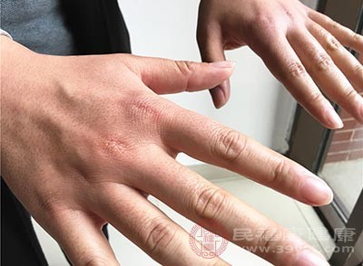 灰指甲患者朋友的指甲板会出现增厚的症状
