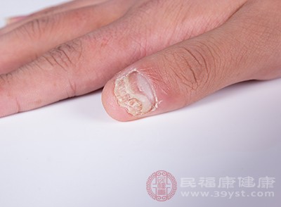 灰指甲出现时患者的指甲受到真菌影响