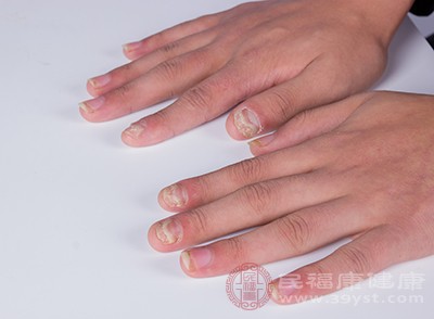 灰指甲的发生会导致指甲颜色出现异常