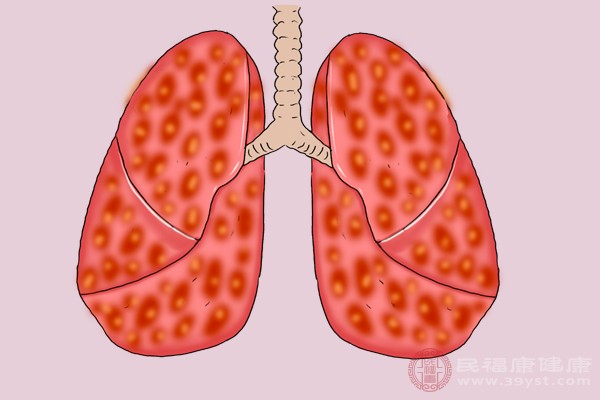 肺癌是临床上最常见的恶性肿瘤疾病