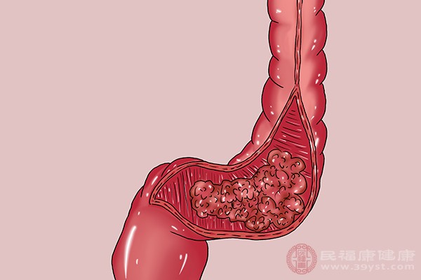 患有結(jié)腸炎也有可能會(huì)引起腹痛