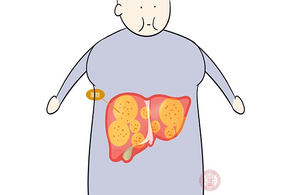 轻度脂肪肝的形成主要是因为的体内的脂肪堆积造成的