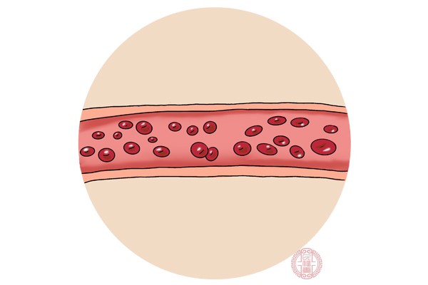 血液粘稠是会影响循环速度，不利于营养物质供给