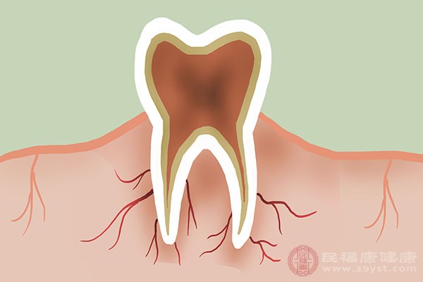 牙龈肿痛主要是由于血液疾病所导致