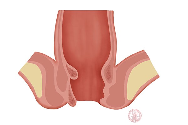 如果患者的痔瘡類型屬于內(nèi)痔，那么就要根據(jù)疾病的進程來確定患者的恢復(fù)時間