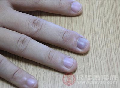 灰指甲會造成自身傳染以及他人傳染