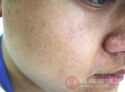 使用错误的护肤品可能会导致皮肤出油严重