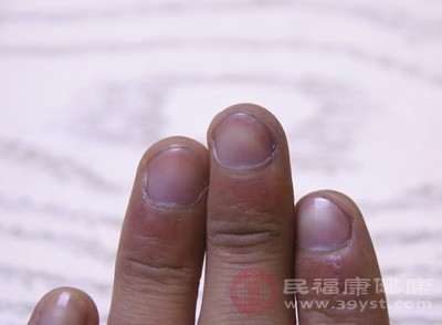 無色或者白色指甲可能與肝癌相關