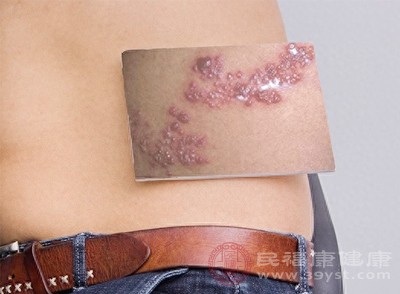 带状疱疹是由水痘病毒激活引起的疾病，其特征是皮肤上出现疱疹
