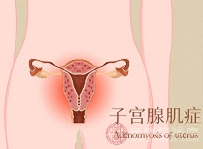 子宫腺肌症是子宫内膜异位症的一种形式，会导致子宫内膜组织在子宫肌层生长，引发月经不调和痛经