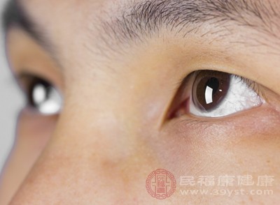 甲亢患者可能会因为眼眶内组织水肿而出现眼球突出的症状