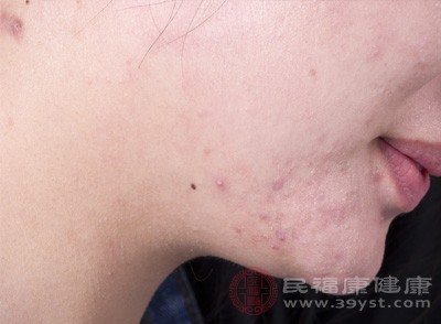 许多女性在月经周期中出现脸部痘痘的爆发，考虑与内分泌的波动有关